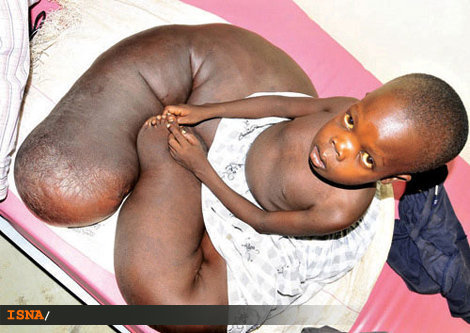 بيمار خیلی عجيب پسر اوگاندايي+ عکس