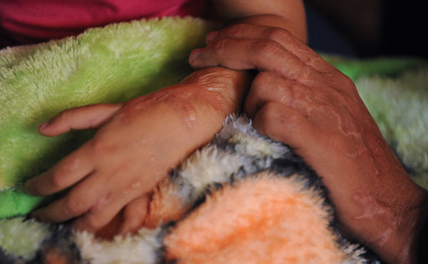 تصاویر:اسیدپاشی بر روی همسر و دختر