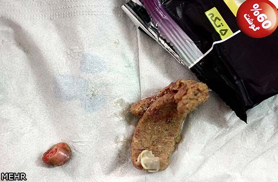 تصاویردلخراش: پیدا شدن انگشت انسان در بسته همبرگر