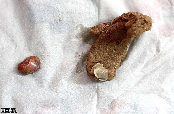 تصاویردلخراش: پیدا شدن انگشت انسان در بسته همبرگر