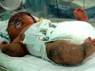 تولد نوزاد شبیه گوریل در غزه+عکس