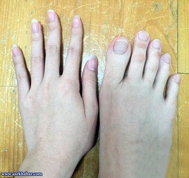 دختری که انگشتان دست و پایش هم‌اندازه‌اند! (+عکس)