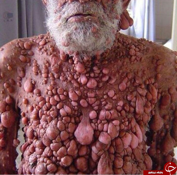 مردی که تمام بدنش تومور دارد +عکس(18+)