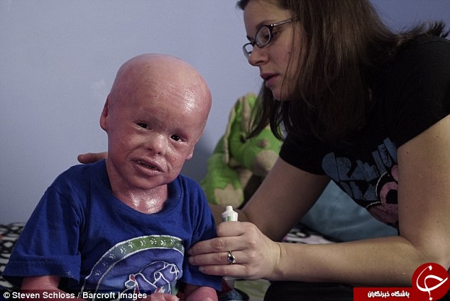 پسری که برای زنده ماندن پوستش کنده می‎شود(عکس)