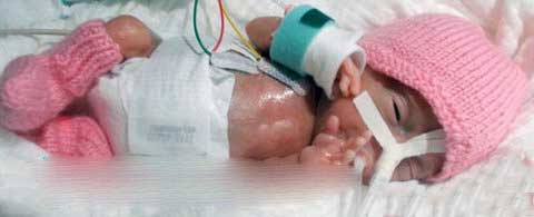 تلاش کوچکترین نوزاد دنیا برای زندگی (عکس)