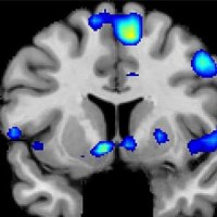 محل HIV در مغز با اسکن MRI قابل تشخیص است