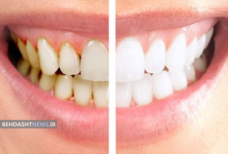 یک ترکیب عالی برای جرم‌گیری دندان