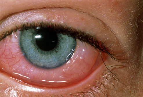 تاثیر اختلال های چشمی روی قدرت بینایی