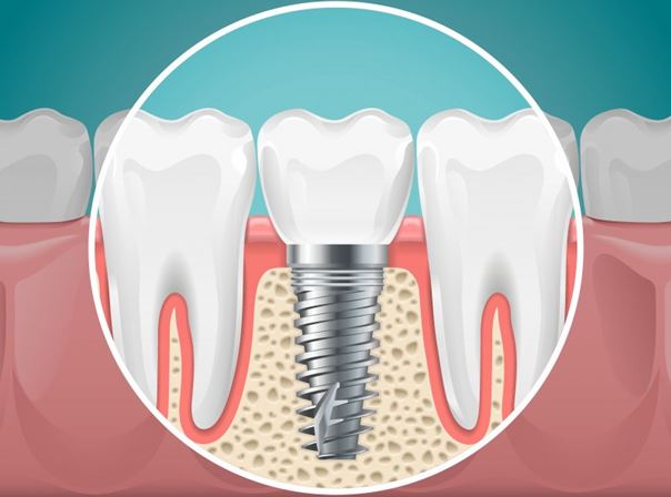 هزینه ایمپلنت دندان با بیمه چقدر است؟
