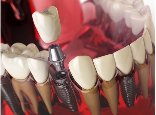 هزینه ایمپلنت دندان با بیمه چقدر است؟