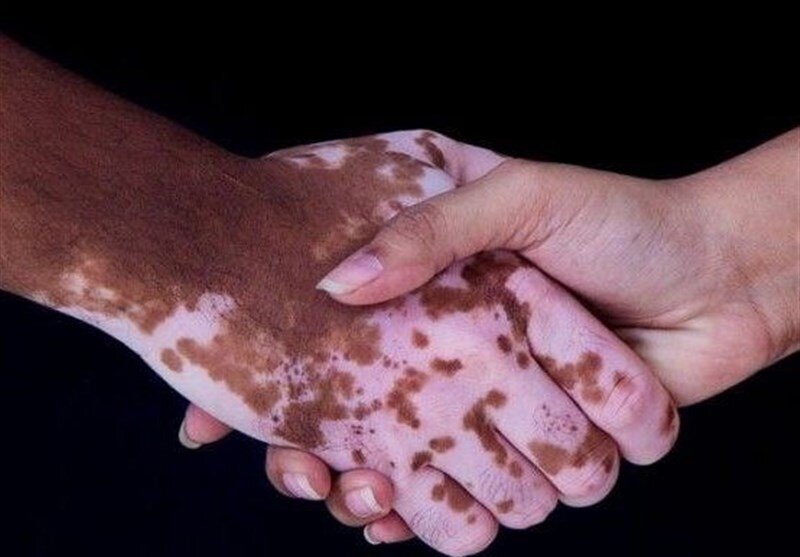 جدیدترین و موثرترین روش درمان یک بیماری پوستی در ایران