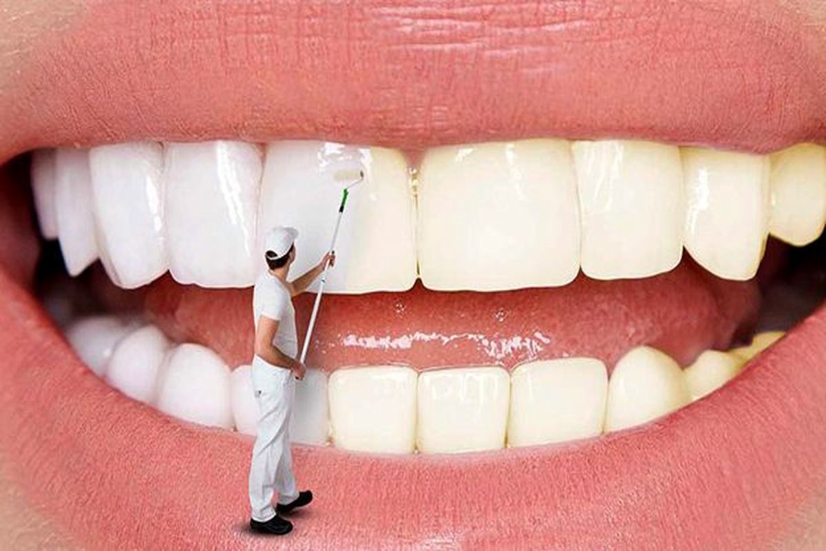 بلیچینگ دندان یا جرم گیری دندان؟ کدام مناسب تر است؟