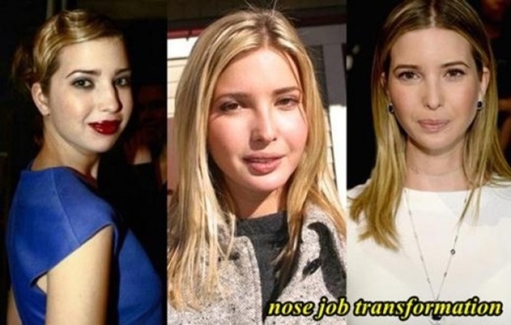 ایوانکا ترامپ قبل و بعد از عمل زیبایی (+عکس)