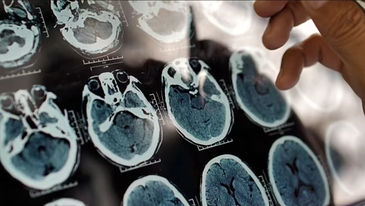 ۵ علامت هشدار دهنده پیری زودرس مغز