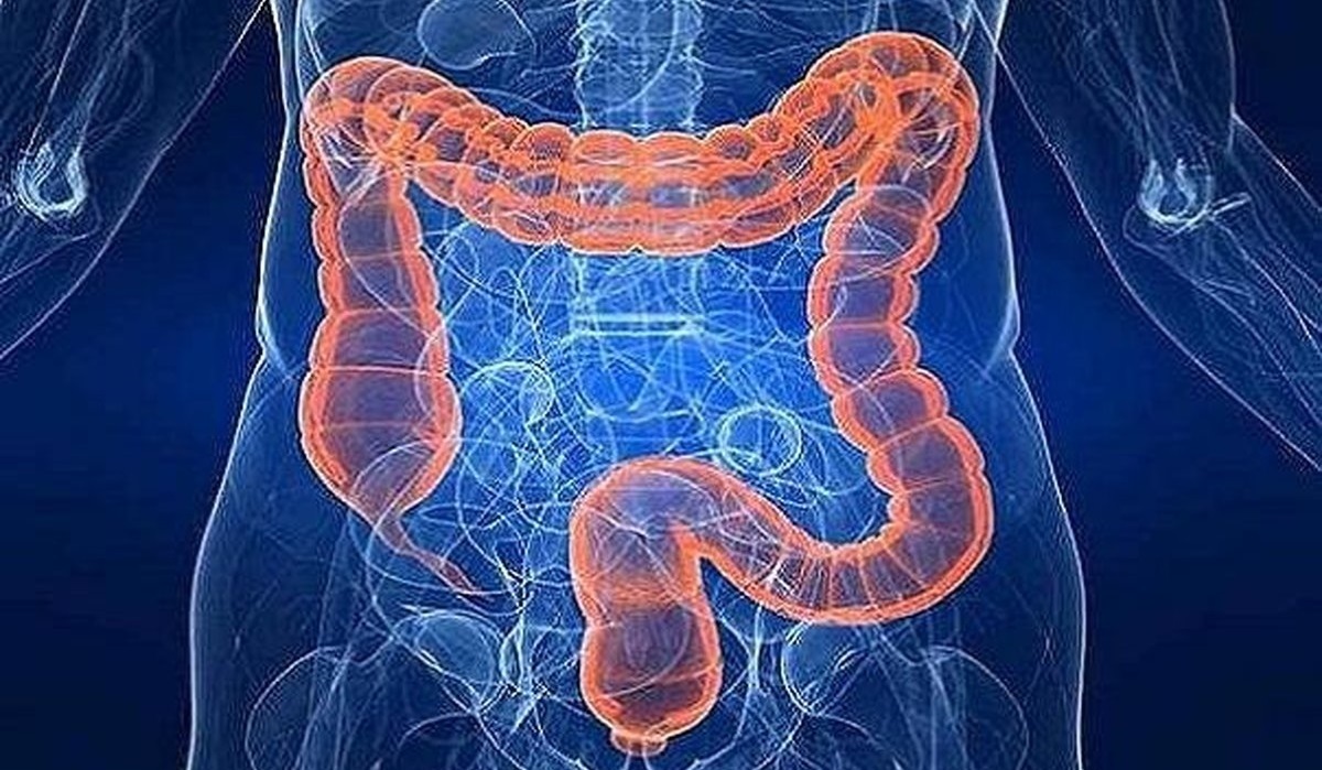 علایم و دلایل بروز سرطان روده بزرگ