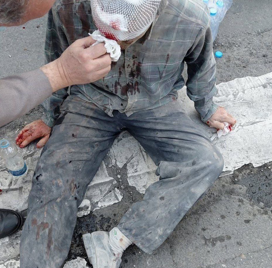 عکسی از مجروح حمله امروز اسرائیل به ایران